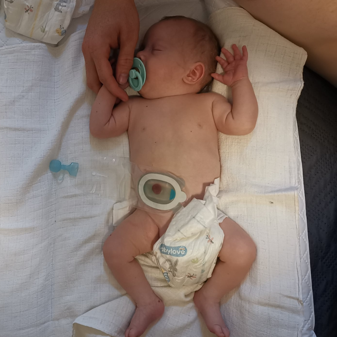 Tomášek, ileostomie u novorozence